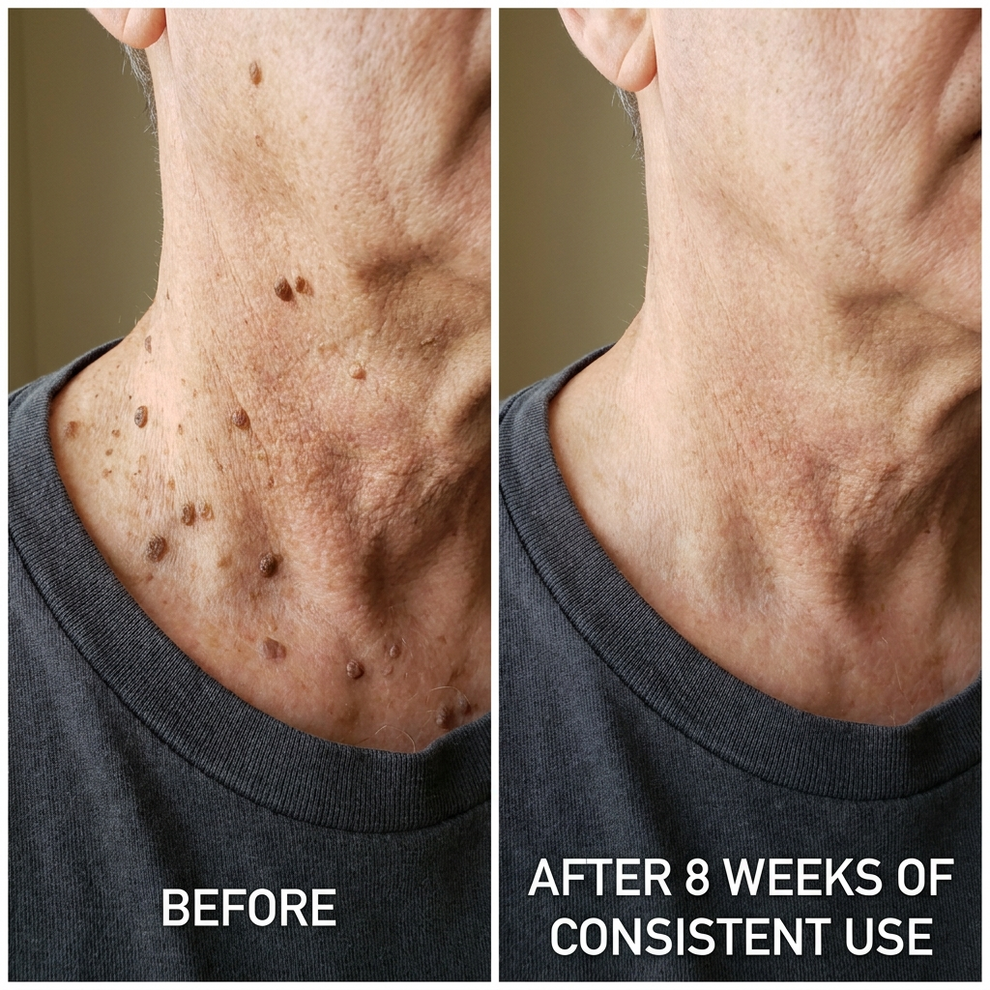 Aluvia™ Advanced Keratolytic Cream For Rough, Raised Seborrheic Keratoses