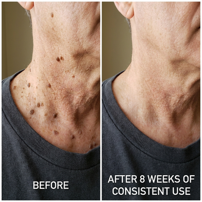 Aluvia™ Advanced Keratolytic Cream For Rough, Raised Seborrheic Keratoses