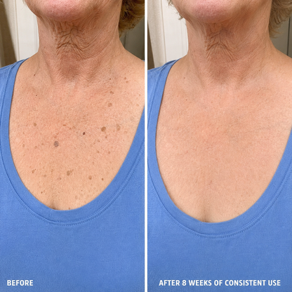 Aluvia™ Advanced Keratolytic Cream For Rough, Raised Seborrheic Keratoses